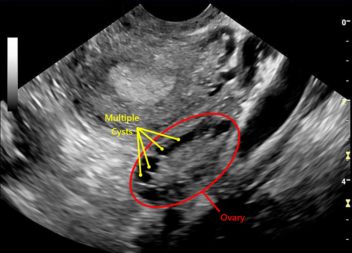 The Pelvic Ultrasound Scan Fertility Test | Conception Advice